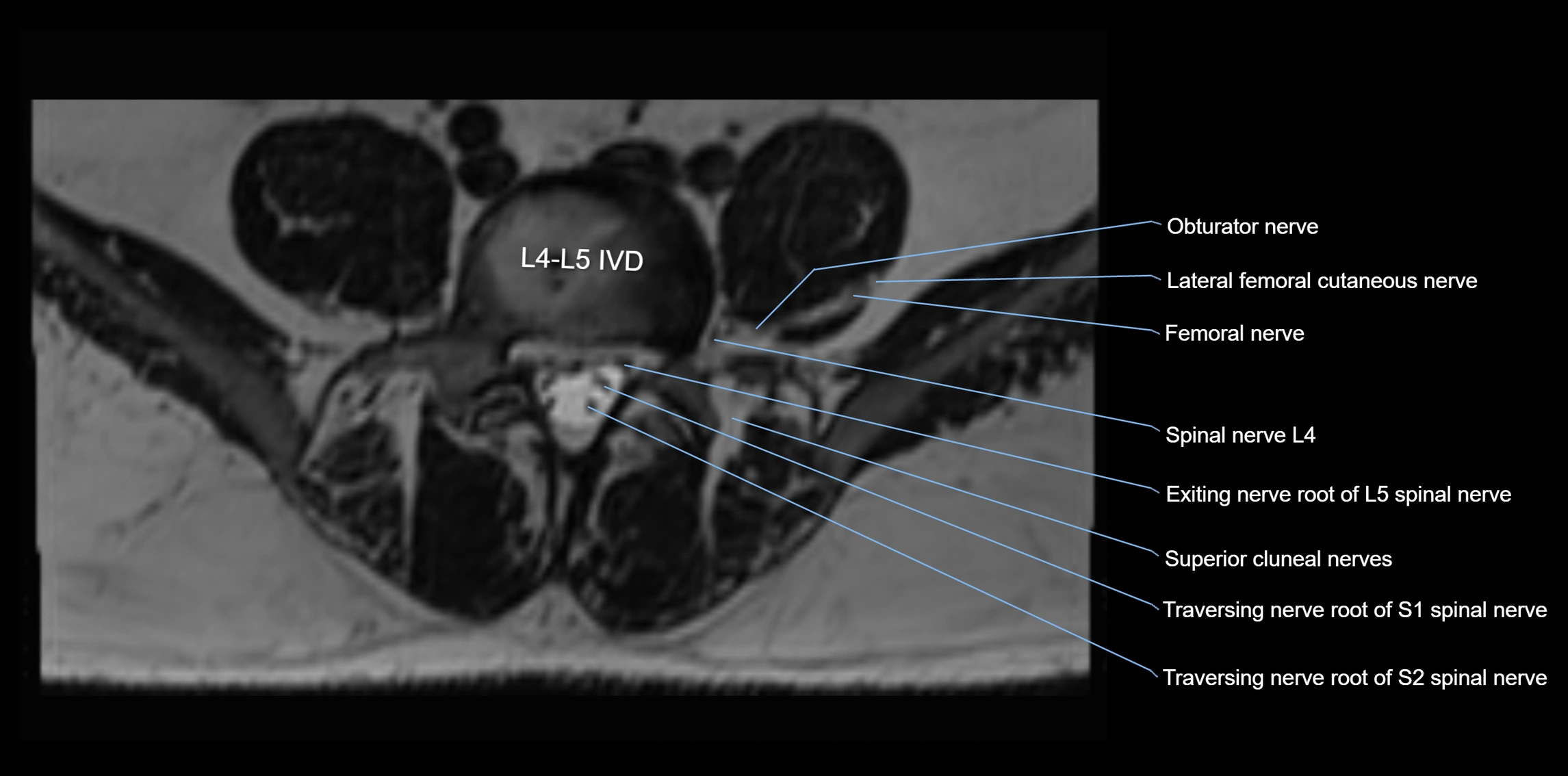 MR lumbosacral plexus axial cross sectional anatomy 3T  radiology  image-img-1008001-00051.webp